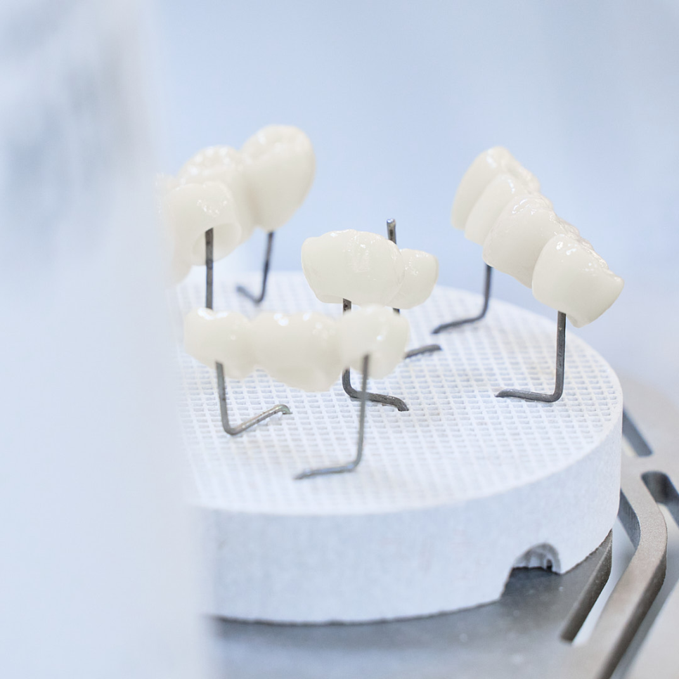 임플란트 이물감, 원인은 미세한 차이? 딱 맞는 보철물, 하루플란트에서 입 안 이물감 해결하기 관련 이미지 4