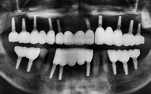 강남역치과 언론이 주목하는 하루플란트치과 변성만 대표원장 관련 이미지 8