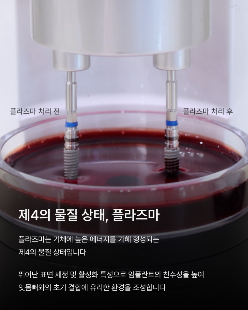 임플란트기간을 줄이고 싶다면? 플라즈마 기술이 주목받는 이유 관련 이미지 2