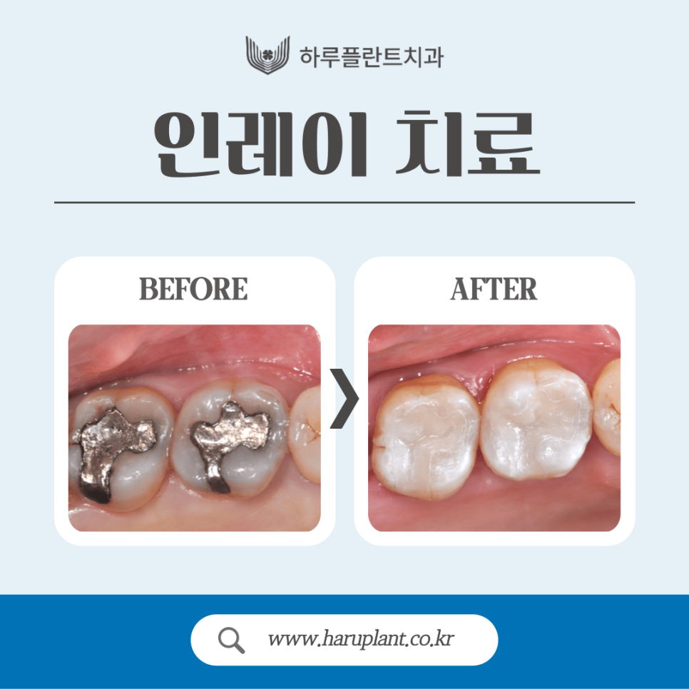 강남충치치료 레진 인레이 차이는? 관련 이미지 4