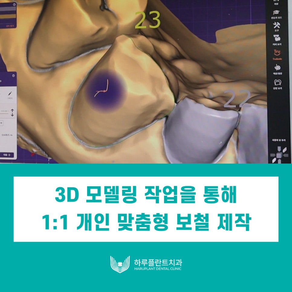 서초동치과 원내기공실이 있는 치과가 좋은이유 관련 이미지 5