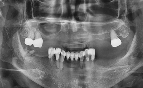 임플란트 뼈이식 수술 후기와 진행과정 공개 관련 이미지 10