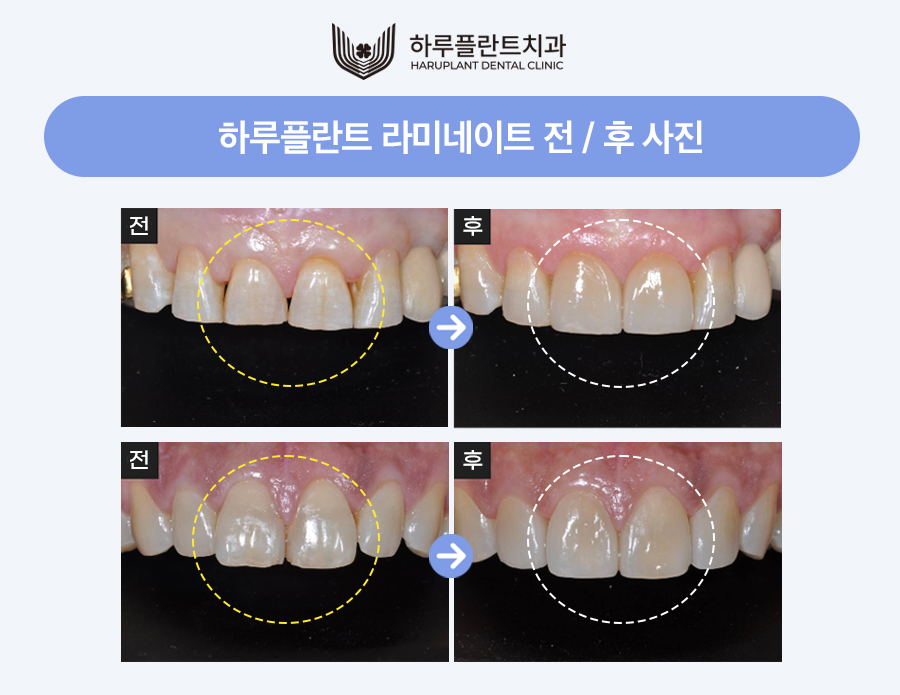 강남 하루플란트치과 라미네이트 후회하지않으려면 관련 이미지 6