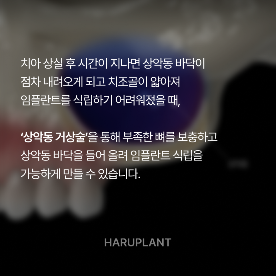 상악동거상술 뜻과 종류로 알아보는 위턱 어금니가 고난도임플란트가 되는 이유 관련 이미지 3
