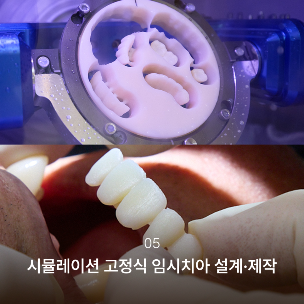 Why the Implant Impression Process Has Changed: The Full Implant Treatment Process at Haru Implant Dental Clinic at Gangnam Station That Makes a Difference in Results image 6