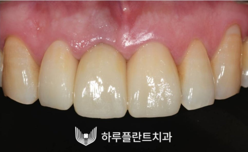 강남역 하루플란트치과 앞니 임플란트 후기 전후차이 관련 이미지 13