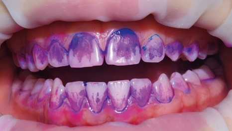 강남역스케일링 통증,시림 없는 프리미엄 에어플로우 스케일링 관련 이미지 7