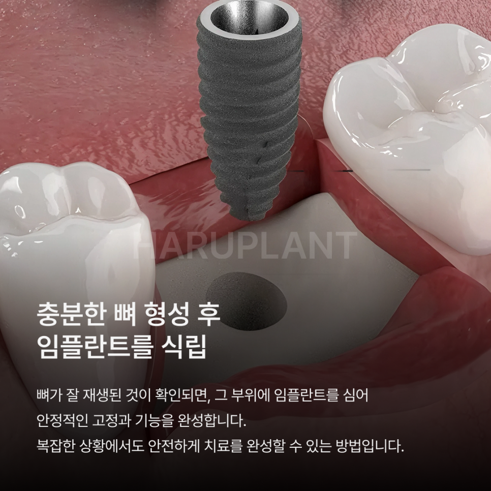 뼈이식임플란트 전 이런 점이 궁금하셨나요? 뼈이식임플란트과정과 기간, 통증까지 정리해드립니다 관련 이미지 8