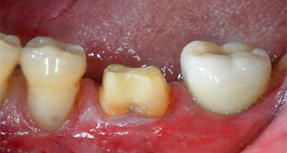 치과당일치료 하루플란트치과의 혁신적인 하루완성 클리닉 관련 이미지 14