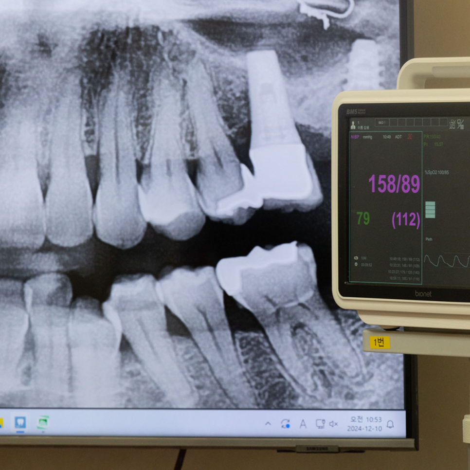 하루플란트 플라즈마 임플란트로 업그레이드된 수명! 안정성이 한 단계 더 향상된 이유는 무엇일까? 관련 이미지 4