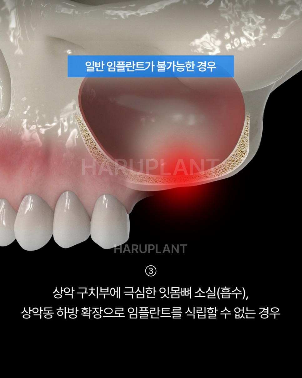 Why All-on-X Implants May Be Worth Considering Even If You Have Been Told That Full-Arch Implants Are Difficult image 5