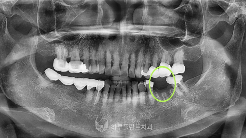 강남구 당일 임플란트 성공의 비결은? 관련 이미지 9