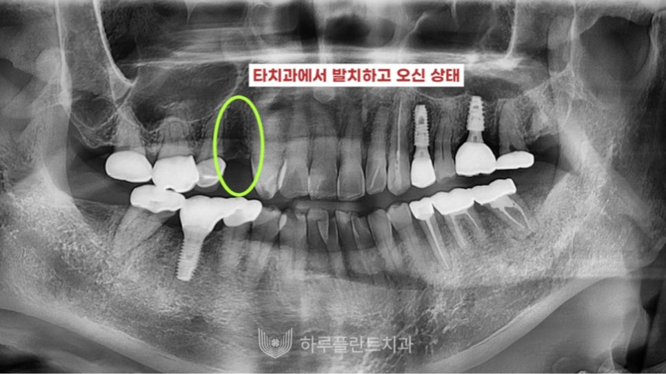 강남구 당일 임플란트 성공의 비결은? 관련 이미지 5