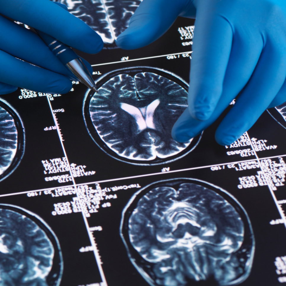 임플란트 치료 미룰수록 치매 발병률이 증가한다? 하루플란트에서 미리 예방하세요! 관련 이미지 2