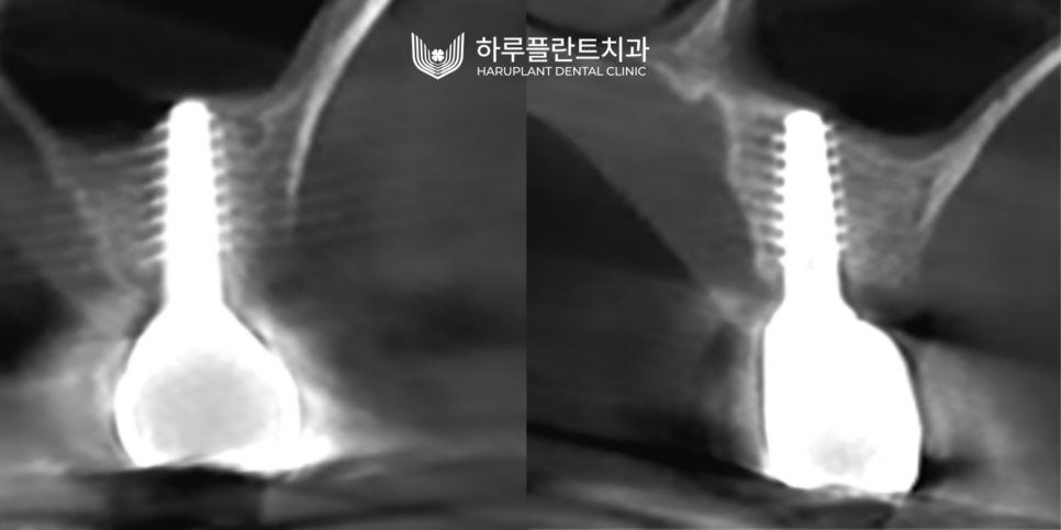 강남역 하루플란트치과 임플란트 무절개 상악동 거상술 진행 케이스 관련 이미지 10