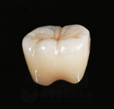 치과당일치료 하루플란트치과의 혁신적인 하루완성 클리닉 관련 이미지 16