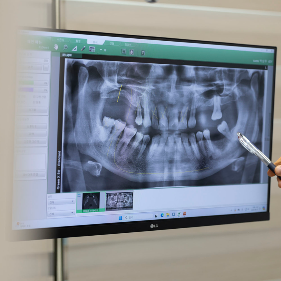 전체 임플란트가 부담된다면 이건 어떠세요? 하루플란트의 실속있는 올온엑스 임플란트 솔루션! 관련 이미지 5