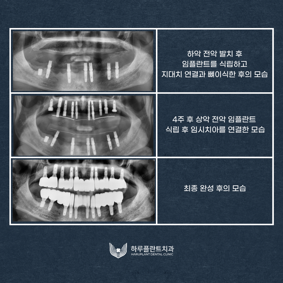 강남역치과 무치악 임플란트 알아보고 있다면 관련 이미지 5