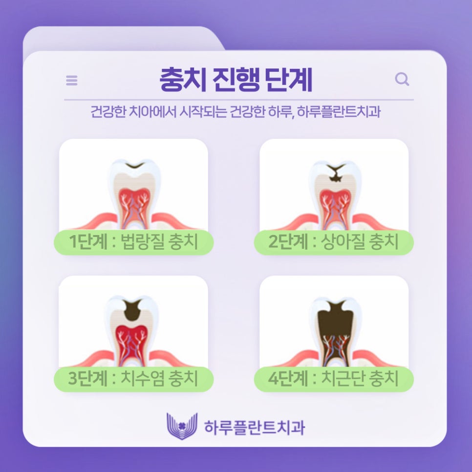 강남역치과 하루플란트치과 충치치료 미루고있다면 관련 이미지 6