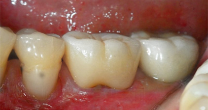 치과당일치료 하루플란트치과의 혁신적인 하루완성 클리닉 관련 이미지 15