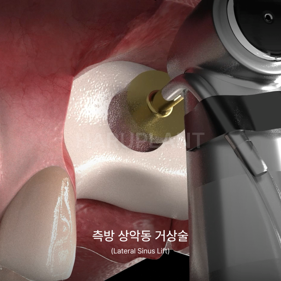 상악동거상술 뜻과 종류로 알아보는 위턱 어금니가 고난도임플란트가 되는 이유 관련 이미지 8