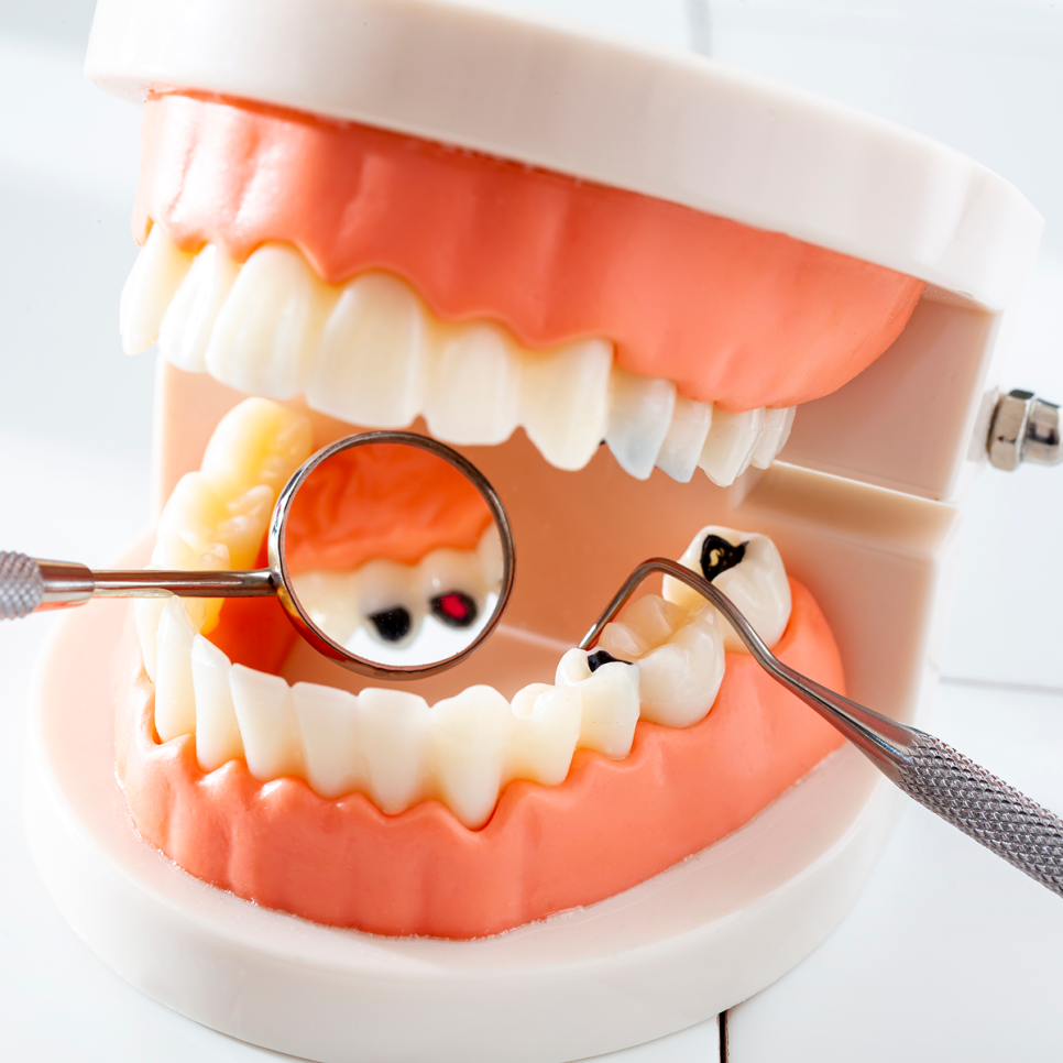 임플란트 하면 충치 걱정 끝? 임플란트 관리, 충치보다 진짜 중요한 건 따로 있어요! 관련 이미지 3