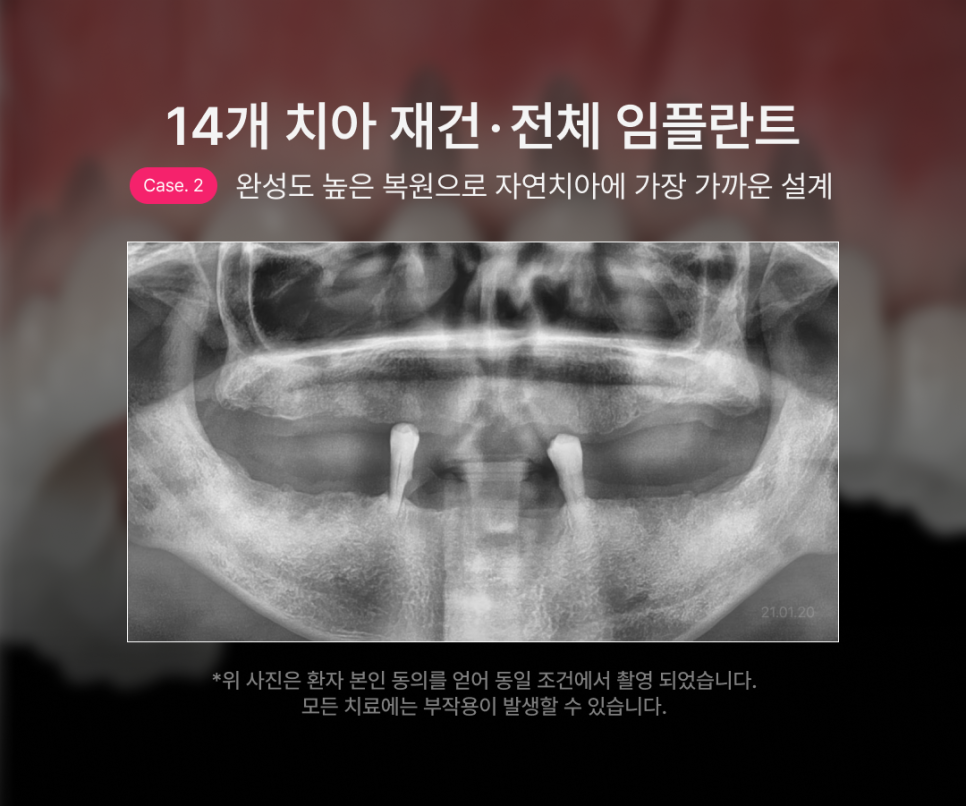 How Many Implants Are Needed for Full-Mouth Implant Treatment? The Type and Cost of Full-Arch Implants Vary Depending on the Number That Suits You image 7