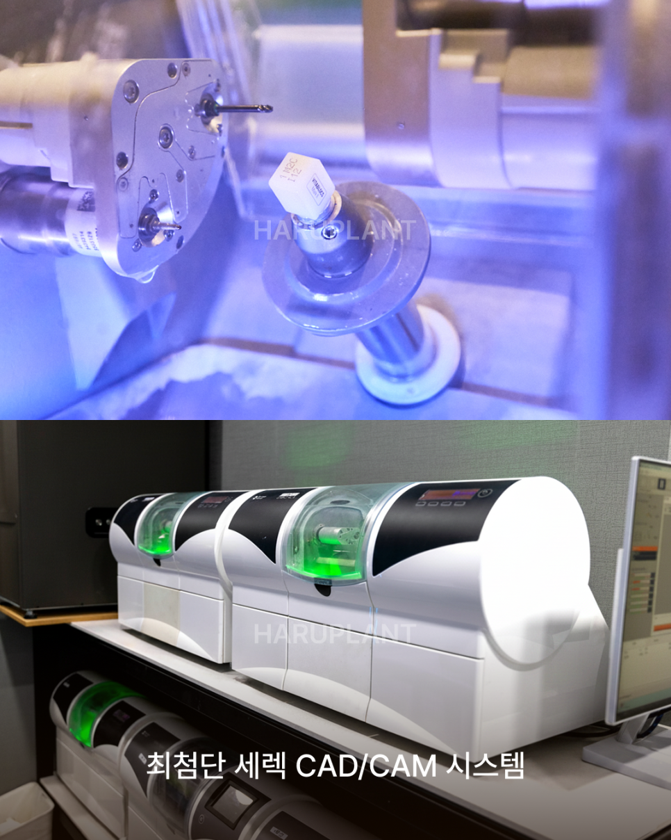How Many Implants Are Needed for Full-Mouth Implant Treatment? The Type and Cost of Full-Arch Implants Vary Depending on the Number That Suits You image 10