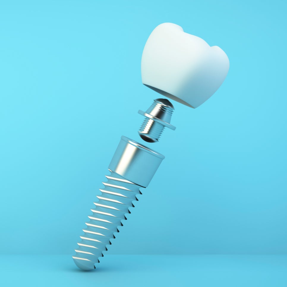 깨끗한 임플란트 표면을 원한다면? 플라즈마로 탄화수소 제거하기 관련 이미지 1