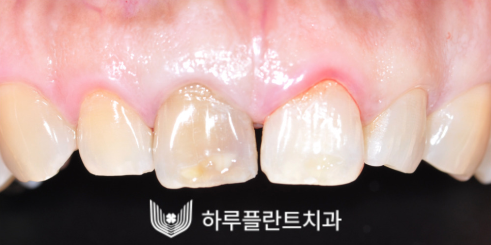 강남역 하루플란트치과 앞니 임플란트 후기 전후차이 관련 이미지 2