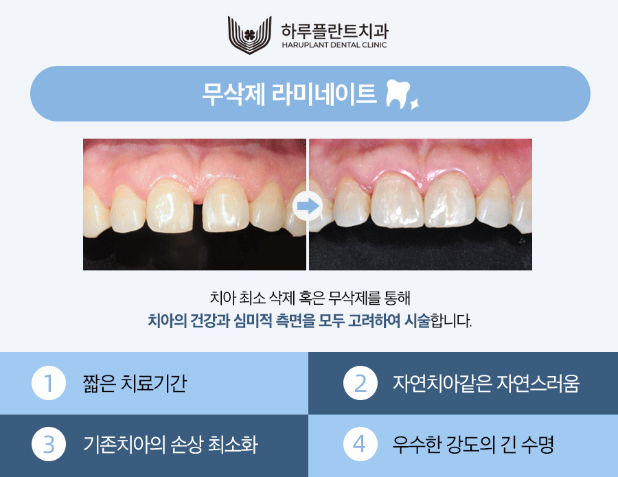 강남 하루플란트치과 라미네이트 후회하지않으려면 관련 이미지 3
