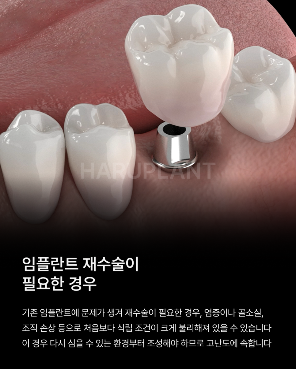 나도 고난도 임플란트 케이스일까? 상악동거상술부터 재수술까지 고난도임플란트종류 알아보기 관련 이미지 5
