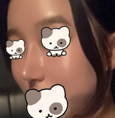 [Gangnam Station Plastic Surgery Hump Nose Surgery Review] I Escaped the Hump That Fillers Couldn’t Fix! It Looks Prettier with a Slim, Straight Line Haha image 7