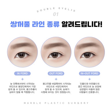 쌍수매몰 이미지 개선을 위해! 마블성형외과 관련 이미지 8