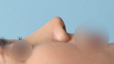 보형물 없이 하는 코수술, 무보형물 코수술이 가능한 경우는? 관련 이미지 6