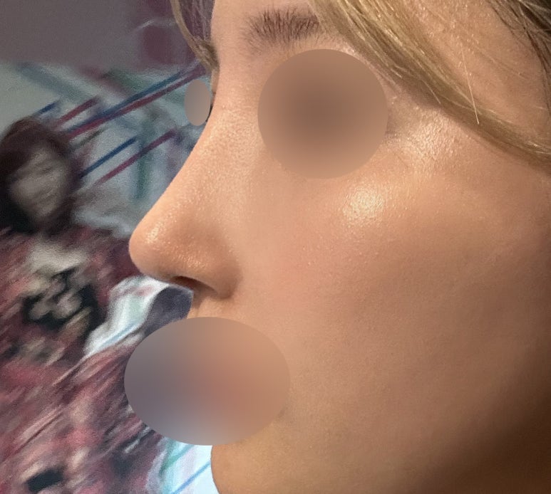 서초구 코수술 잘하는곳 마블성형외과에서 예쁜 코라인으로 변화 관련 이미지 4