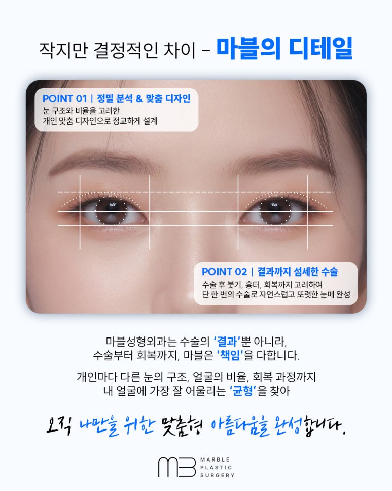 수험생눈성형 알아 볼 때 고려해야 할 것은? 관련 이미지 3