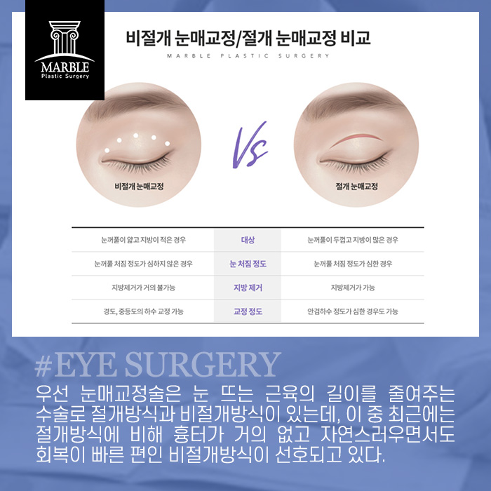 눈매교정수술 혹시 안검하수일까요?마블성형외과의원 관련 이미지 7