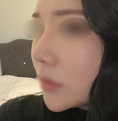 [Gangnam Plastic Surgery Revision Rhinoplasty Review] My bulbous nose showed no improvement at all… I found the nose shape I’ve always wanted after meeting Dr. Junhyung Kim haha image 5
