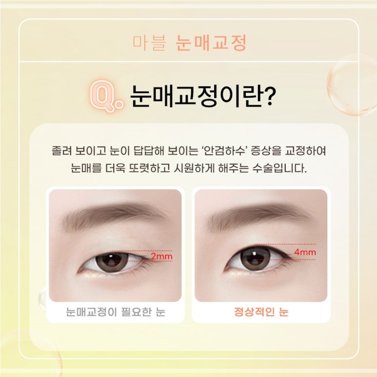 비절개눈매교정잘하는곳 장점, 선택 시 고려사항, 비용 관련 이미지 4