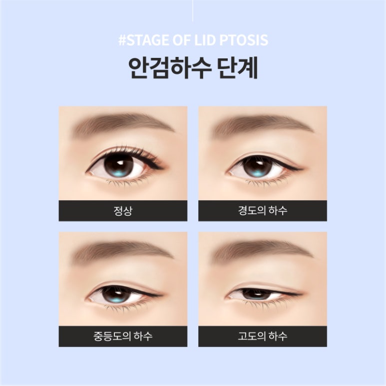 눈매교정 부작용 무엇이 있을까? 관련 이미지 4