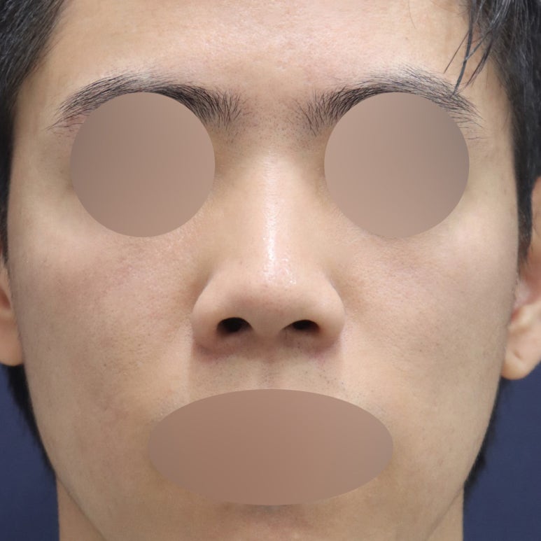 Improving Your Impression Before and After Male Rhinoplasty image 1