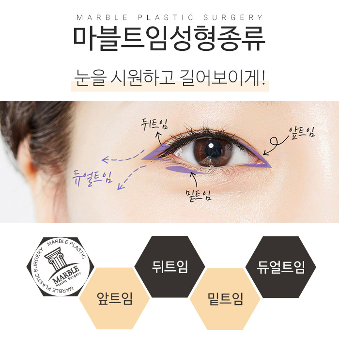 뒷트임밑트임후기 크고 또렷한 눈으로 관련 이미지 2