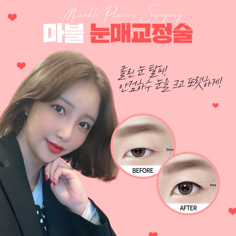 안검하수수술비용 부담되시나요? 관련 이미지 1