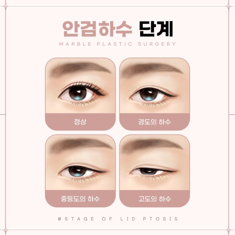 눈성형잘하는곳의 수술과 눈매교정에 대하여 관련 이미지 7