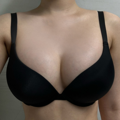 [강남성형외과 가슴확대수술 후기] 평생 고민이었던 짝가슴.. 원장님표 완벽한 대칭에 볼륨 대만족! 관련 이미지 6