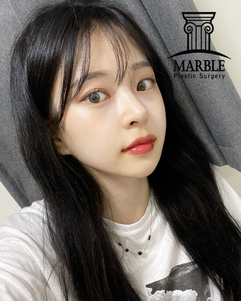 눈수술(눈성형) 후, 알아두면 좋은 주의사항 정리! 관련 이미지 1