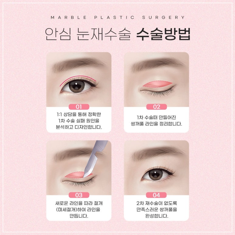 쌍수 눈재수술잘하는곳의 쌍꺼풀재수술 : 안전성, 심미적 측면, 비용 가격 등 관련 이미지 3