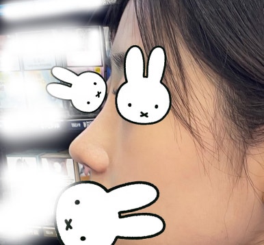 [강남성형외과 복코성형 후기] 두꺼운 피부라 얄쌍해지기 어렵다던 제 복코.. 지금은 콧볼까지 얇아졌어요 관련 이미지 7