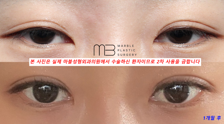 눈재수술 잘 알아봐야 관련 이미지 3